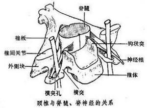 胸椎結核椎旁膿腫穿入胸腔