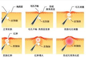 雞皮膚形成機制