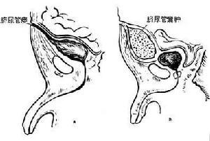 臍尿管囊腫及臍尿管瘺