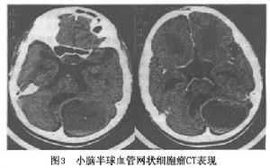 腦內血管網狀細胞瘤