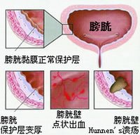 泌尿系統疾病