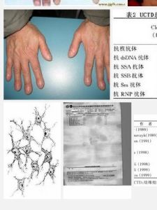 未分化結締組織病