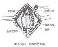 恥骨直腸肌綜合徵