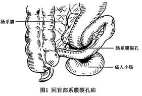 腸系膜裂孔疝