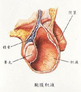 鞘膜積液