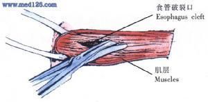 食管破裂