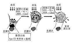 高尿酸血症腎病