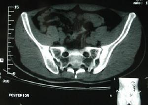 （圖）退變性骶髂關節炎