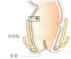 肛裂三聯症