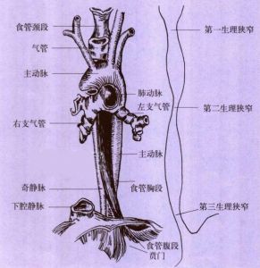 人體食管的狹窄