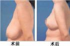 乳房下垂上提術