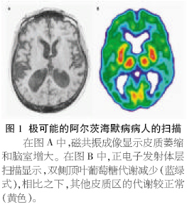 阿爾茨海默病性痴呆