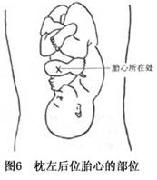 持續性枕後位難產