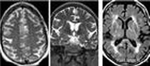 異染性腦白質營養不良