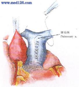 肺動脈狹窄