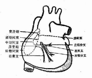 典型預激綜合徵