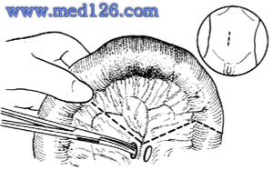 《腸吻合的基本縫合法及小腸吻合術》