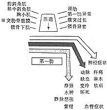 肋鎖綜合徵