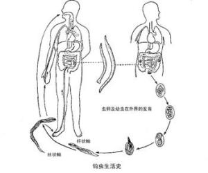 鉤蟲病