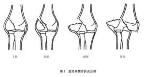 肱骨外髁骨折