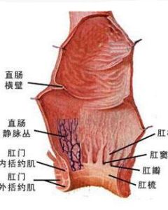 肛乳頭肥大