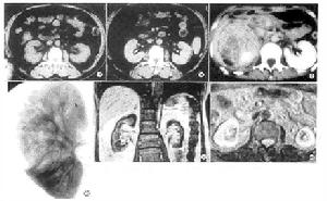 老年人慢性腎盂腎炎