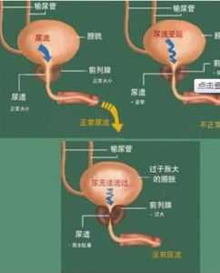 神經源性膀胱