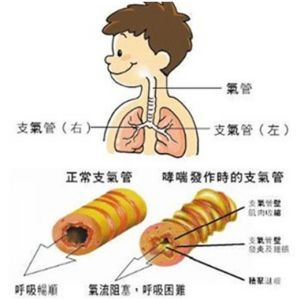 變異性哮喘疾病