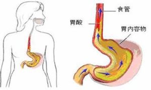 反流性咳嗽