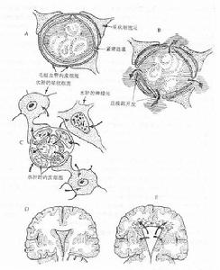 顱內脊索瘤