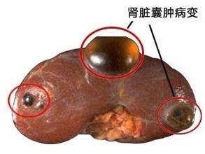 獲得性腎囊腫