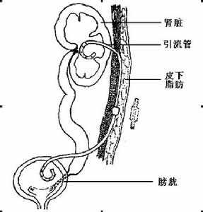 膀胱造瘺