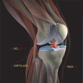 十字韌帶撕裂
