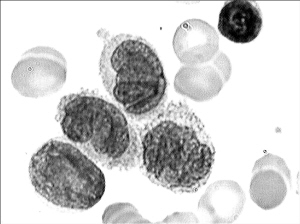 （圖）艱難梭狀芽孢桿菌小腸結腸炎