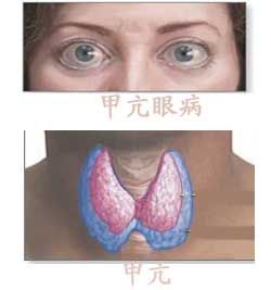 突眼性甲狀腺腫