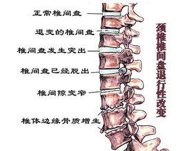 頸椎椎節已有明顯退行性變