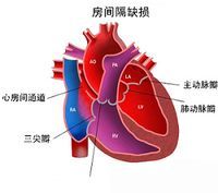 先天性心臟病