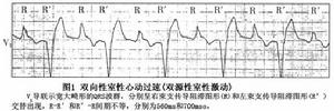 雙向性室性心動過速