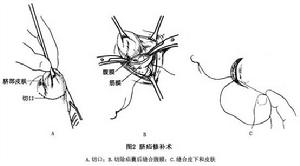 嬰幼兒臍疝 圖2