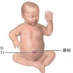 嬰幼兒臍疝