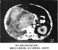 腹膜後腫瘤