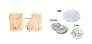 乳房假體取出術