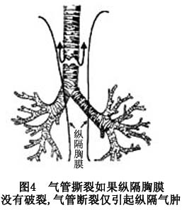 創傷性氣管及主支氣管損傷