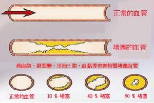 溶栓活血系統療法