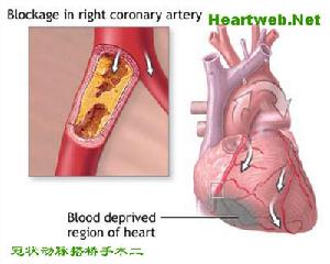 缺血性腸病