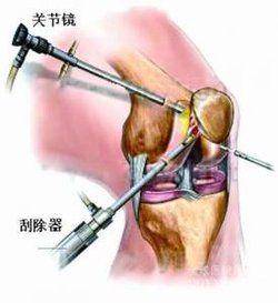 關節粘連松解灌洗術