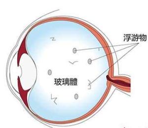 飛蚊症