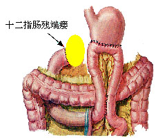 十二指腸壅滯症