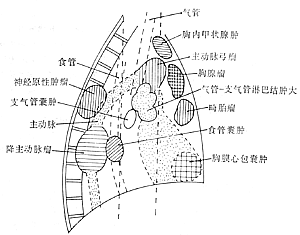 原發性心臟腫瘤