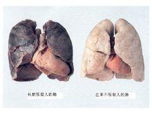 左為吸菸者的肺，右為不吸菸者的肺